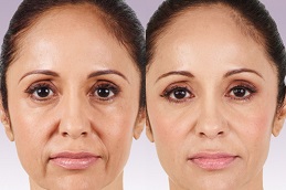 حقن التجميلية دبي