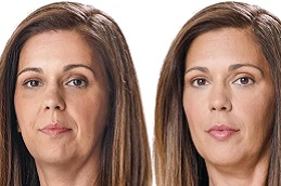 حقن التجميلية في دبي