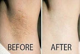 علاج تبييض الإبط في دبي