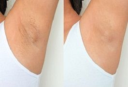 علاج تبييض الإبط في دبي