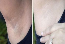 علاج تبييض الإبط في دبي