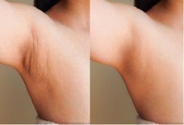 علاج تبييض الإبط في دبي