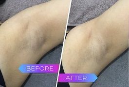 علاج تبييض الإبط في دبي