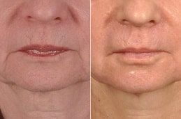 علاج ديرمابين في دبي وأبو ظبي والشارقة | تكلفة ديرمابين