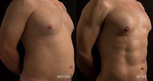 شفط الدهون عالي الوضوح في دبي وأبو ظبي والشارقة ديناميكي