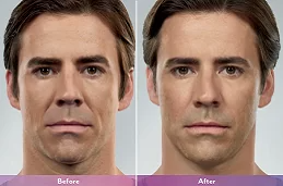 تكلفة الحقن التجميلي دبي