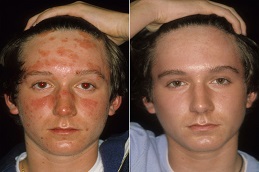 علاج البثور في دبي والإمارات العربية المتحدة