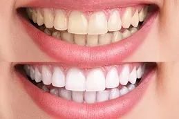 تبييض الأسنان ببيروكسيد الهيدروجين في دبي والشارقة