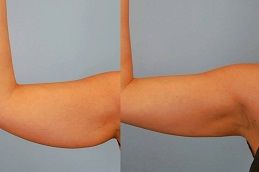 عملية شد الذراعين في الإمارات العربية المتحدة