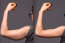 عملية شد الذراعين في دبي