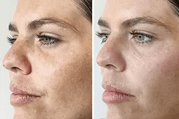 تكلفة علاج تصبغ الجلد