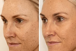 علاج تصبغ الجلد في أبوظبي