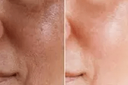 علاج تصبغ الجلد في دبي