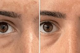 علاج تصبغ الجلد